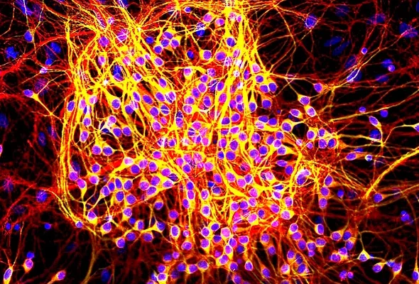 Obscure Disease May Offer Backdoor to New Treatments for Alzheimer’s and Other Killers