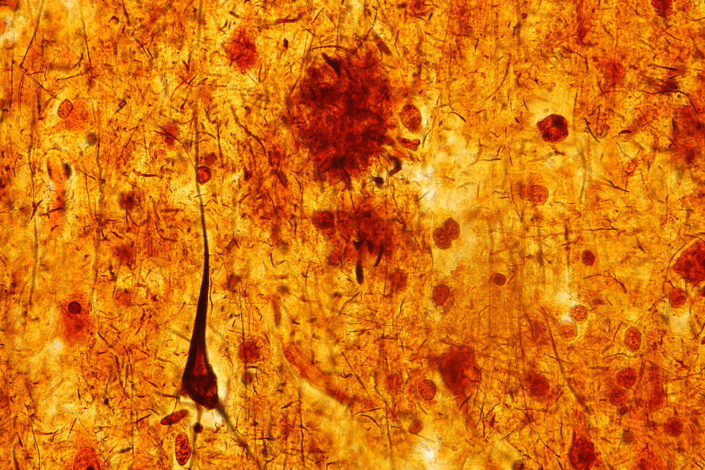 A slice of brain tissue from a person who died with dementia shows an elongated brown triangle – a toxic tangle of tau protein associated with Alzheimer's disease and brain damage. A study in mice and people from Washington University School of Medicine in St. Louis shows that sleep deprivation causes tau levels to rise and tau tangles to spread through the brain, accelerating Alzheimer's brain damage.