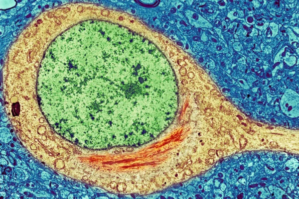 Alzheimer’s Disease May Develop Differently In African-Americans, Study Suggests