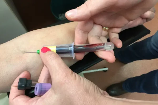 Blood test detects Alzheimer’s plaques building up in brain