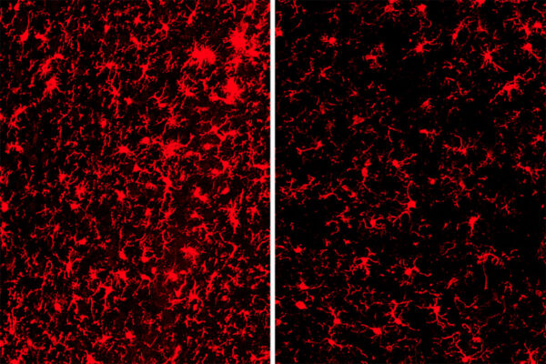 Alzheimer’s gene poses both risk — and benefits