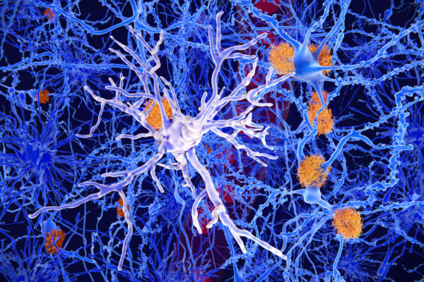 How a hyperactive cell in the brain might trigger Alzheimer’s disease