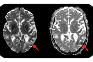 A new study from Washington University School of Medicine in St. Louis suggests a simple blood test — administered before CAR-T cell treatment is initiated — may identify which patients are predisposed to developing neurotoxic side effects after CAR-T cell therapy. Severe side effects can include seizures, brain swelling and strokes. Evidence of a stroke (red arrows) is seen on this MRI scan of the brain of a patient who developed neurotoxic side effects after CAR-T cell therapy.