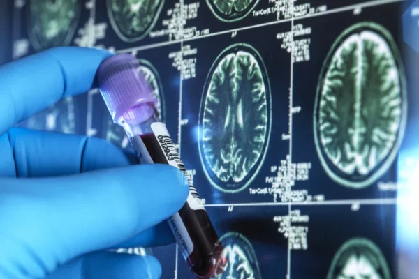 Blood tests can help diagnose Alzheimer’s — if they’re accurate enough. Not all are
