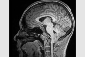 An MRI scan shows a Chiari type-1 malformation, in which the cerebellum extends beyond the gap in the skull where it connects to the spinal cord. Researchers at Washington University School of Medicine in St. Louis have used AI tools to describe three sub-types of Chiari type-1, which will help guide clinicians to make the most effective treatment decisions for their patients.