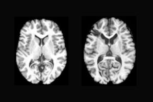 A new study led by WashU Medicine researchers has found older-looking brains in adults with sickle cell disease, helping to explain the cognitive challenges experienced by such individuals. A brain image from a healthy individual (left) shows a larger brain with more white matter compared with a brain image from a patient with sickle cell disease (right). Healthy individuals experiencing economic deprivation also had more-aged appearing brains.