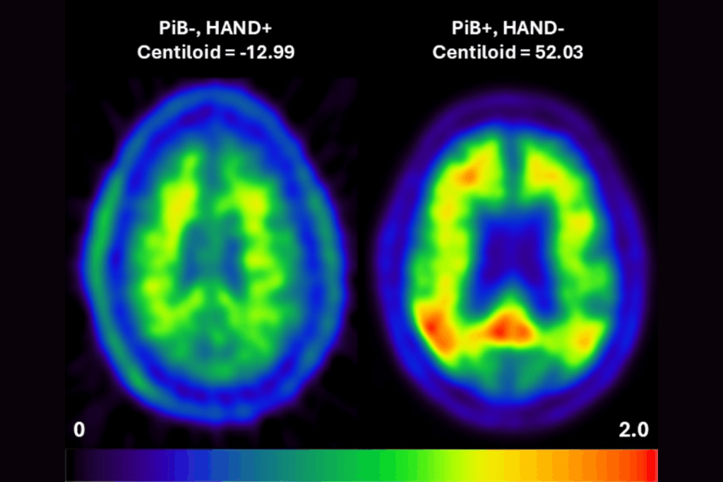 PET scan images demonstrating absence of amyloid in a patient with HIV cognitive impairment contrasting with image confirming aggregated amyloid in reported patient with Alzheimer Disease.