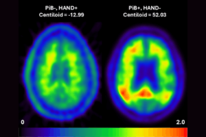 PET scan images demonstrating absence of amyloid in a patient with HIV cognitive impairment contrasting with image confirming aggregated amyloid in reported patient with Alzheimer Disease.