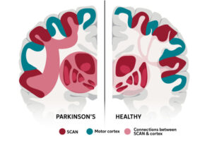 The brain network that links thinking with movement, called SCAN, was first described by WashU Medicine researchers in 2023 and has been identified in a new study as the neurological basis of Parkinson’s disease. An experimental therapy that targeted this network more than doubled symptom improvement in a small group of patients with Parkinson’s, which is characterized by hyperconnectivity (left side of illustration) between SCAN and the brain’s subcortex.