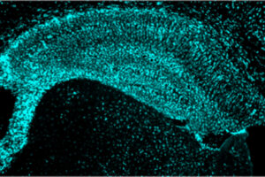 Mice prone to developing Alzheimer’s-like brain damage have potentially damaging activated immune cells in their brains (above). Researchers at Washington University School of Medicine in St. Louis have found that high levels of a normal protein associated with reduced heart disease also protect against Alzheimer’s-like damage in mice, opening up new approaches to slowing or stopping brain damage and cognitive decline in people with Alzheimer’s.