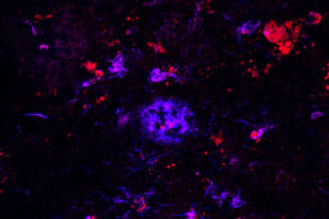 Antibodies against APOE (red) bind to amyloid plaques (blue) in brain tissue from people with Alzheimer's disease. Researchers have found that the antibody can sweep away the damaging plaques, at least in mice, which could lead to a therapy for the devastating disease.