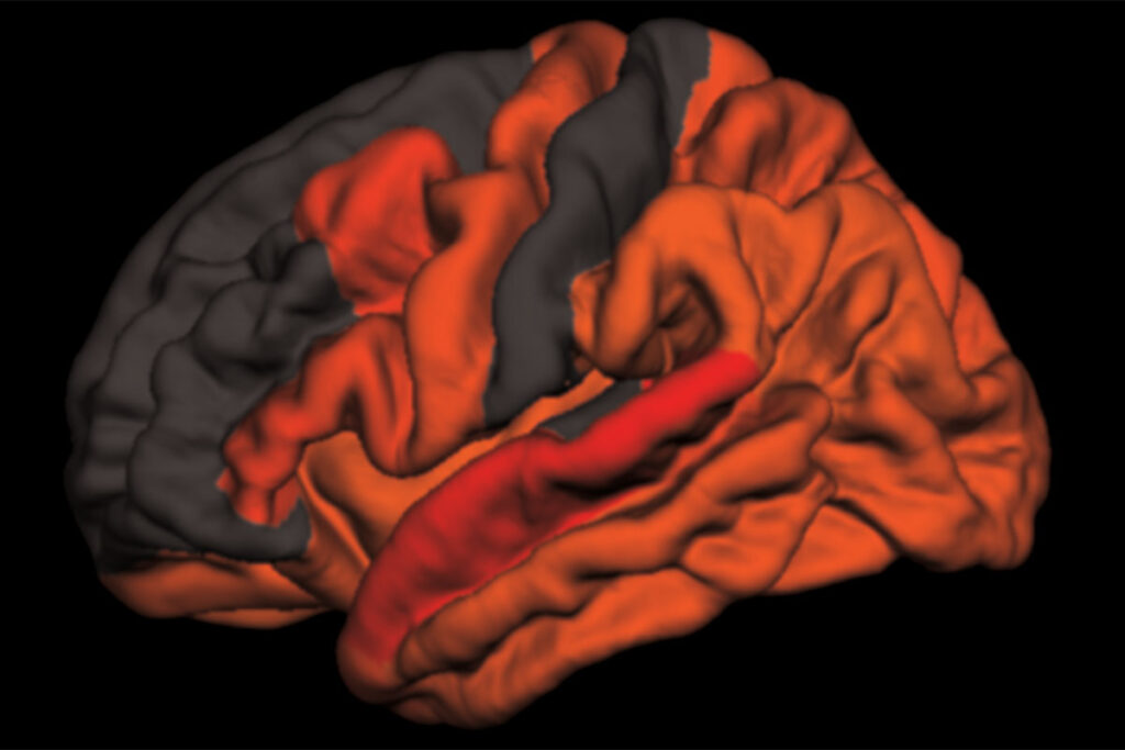 Reduced amounts of slow brain waves – the kind that occur in deep, refreshing sleep – are associated with high levels of the toxic brain protein tau. This computer-generated image maps the areas where the link is strongest, in shades of red and orange. A new study from Washington University School of Medicine in St. Louis has found that decreased deep sleep is associated with early signs of Alzheimer’s disease.