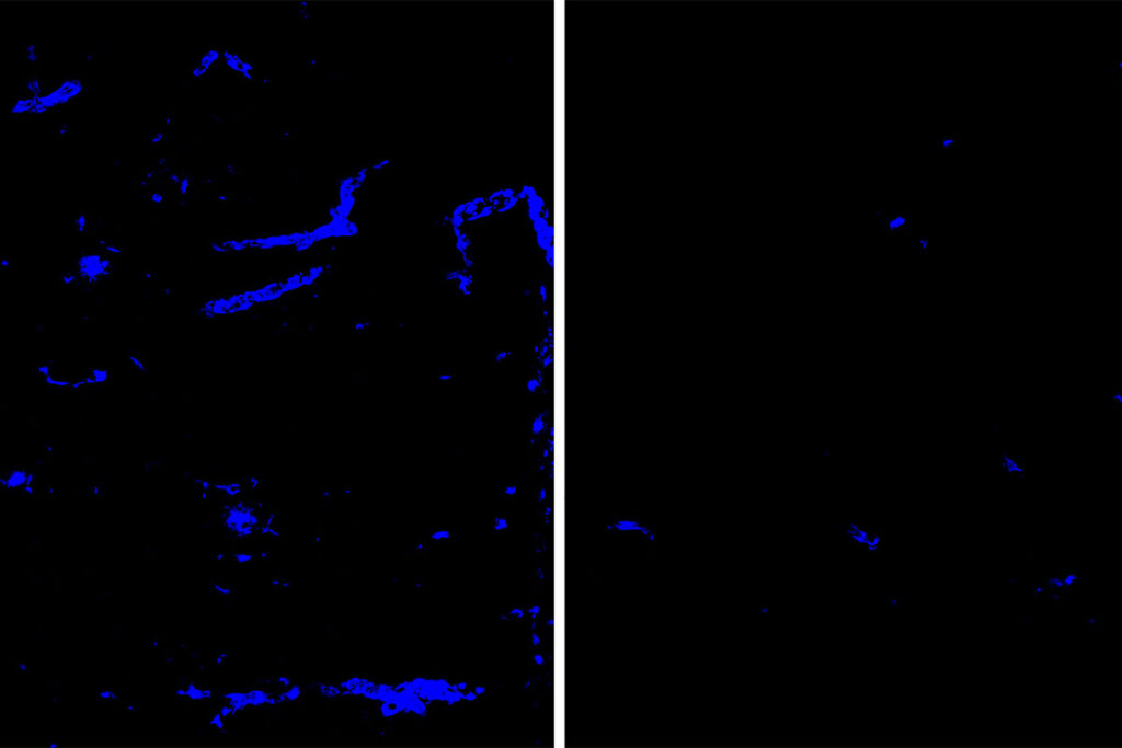 Amyloid deposits (blue) in mouse brain tissue and blood vessels are reduced after treatment with an antibody that targets the protein APOE (right), a minor component of amyloid deposits, compared to a placebo antibody (left). Amyloid deposits in the brain increase the risk of dementia and strokes. Researchers at Washington University School of Medicine in St. Louis have identified an antibody that clears amyloid deposits from the brain without raising the risk of brain bleeds.