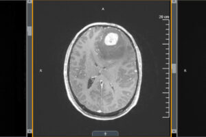 A new study from Washington University School of Medicine in St. Louis shows that treatment with an immune-boosting protein called interleukin 7 (IL-7) in combination with radiation improves survival in mice with glioblastoma. Shown is an MRI scan of the brain of a patient with glioblastoma.