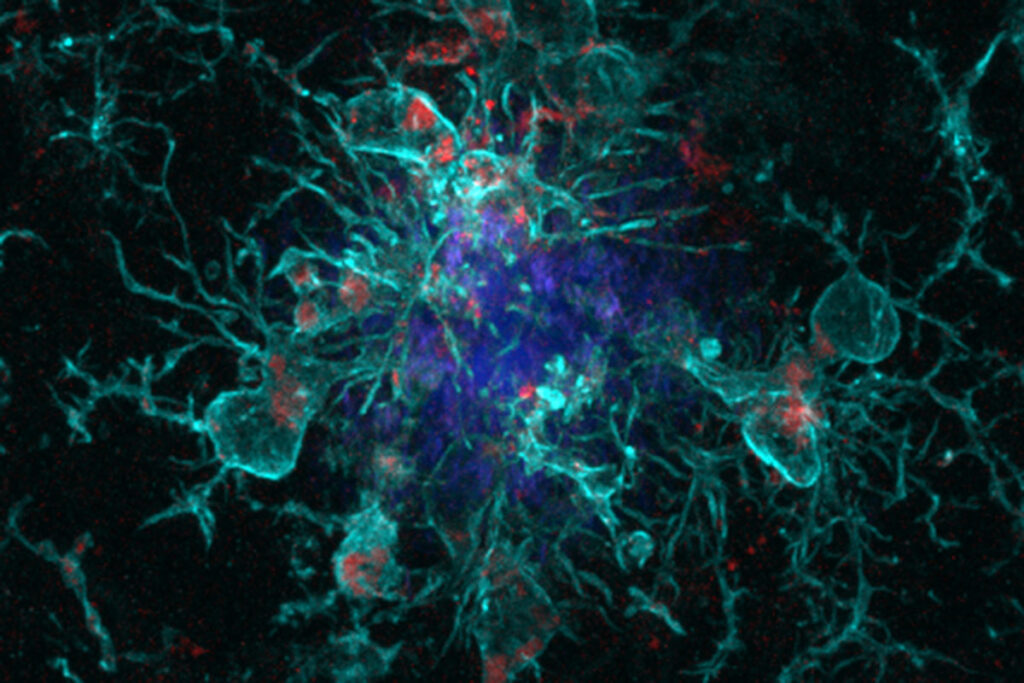 Immune cells known as microglia (turquoise with red dots) surround a plaque of the Alzheimer’s protein amyloid (blue). The red dots indicate that the microglia are prepared to remove the potentially damaging plaque. Researchers at Washington University School of Medicine in St. Louis have discovered a protein that links the amyloid-removal process to the circadian clock. The protein, YKL-40, could help explain why people with Alzheimer’s frequently suffer from sleep disturbances, and provide a new target for Alzheimer’s therapies.