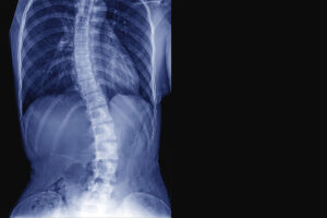 An inability to properly use the essential mineral manganese could be to blame for some cases of severe scoliosis, according to a new study from Washington University School of Medicine in St. Louis.