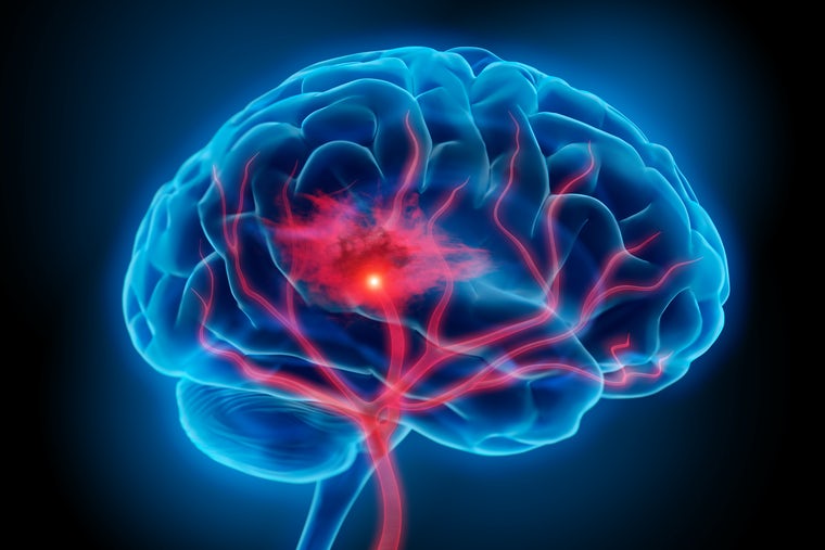 A Washington University in St. Louis team will study how the brain recovers from ischemic stroke with a $3.12 million grant from the National Institutes of Health. (Image: iStock photo)