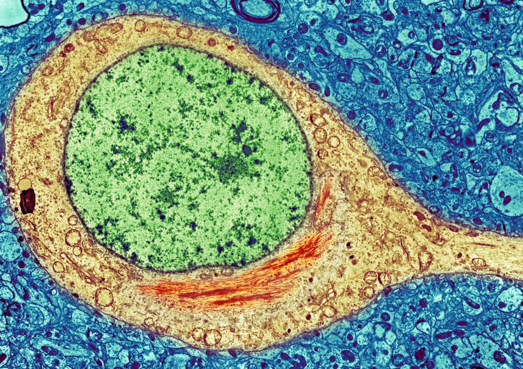 A colorized image of a brain cell from an Alzheimer's patient shows a neurofibrillary tangle (red) inside the cytoplasm (yellow) of the cell. The tangles consist primarily of a protein called tau.