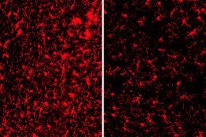 Immune cells are more activated (red) in the brains of mice with the gene TREM2 (left) than in those without the gene (right). A new study shows that having a working copy of the gene TREM2 can reduce risk of Alzheimer’s disease under certain conditions but worsen disease in others.