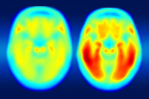 A study using a new PET imaging agent shows that measures of tau protein in the brain more closely track cognitive decline due to Alzheimer’s disease compared with long-studied measures of amyloid beta. More red color indicates more tau protein. The image on the left shows the average tau accumulation in the brains of cognitively normal people, averaged over many individuals. The image on the right shows the average amount of tau buildup in the brains of multiple people with mild Alzheimer’s symptoms. Scanning multiple individuals shows that the intensity of tau deposits correlates with the severity of cognitive dysfunction. (Image: Matthew R. Brier)