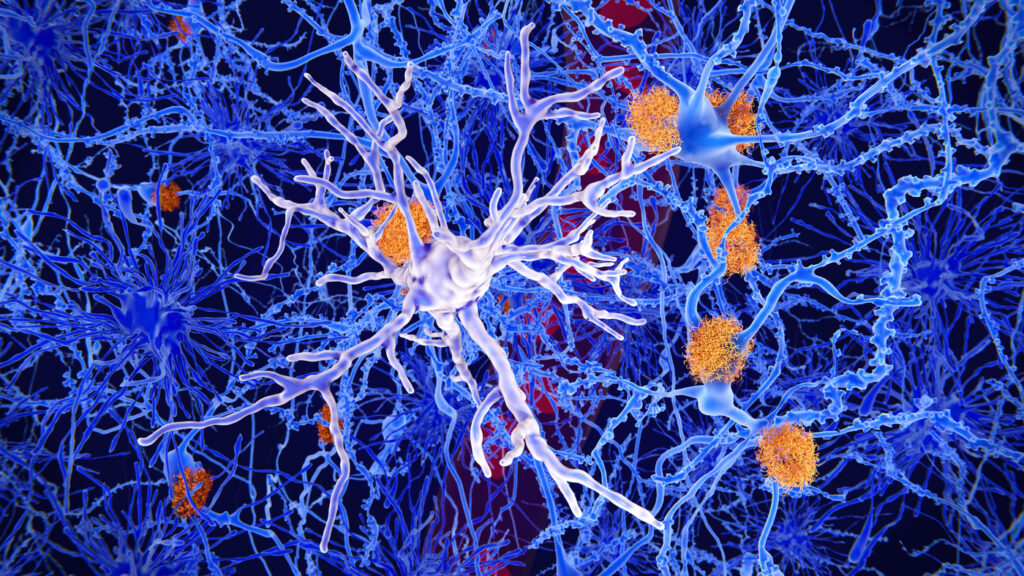 Microglia, specialized cells like the one seen in the center of this image, can restrain the accumulation of beta-amyloid protein (plaques in orange) that are a hallmark of Alzheimer's disease. But the cells sometimes contribute to the progression of the illness, researchers say.