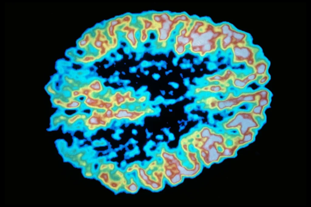 A PET scan shows metabolism of sugar in the human brain.