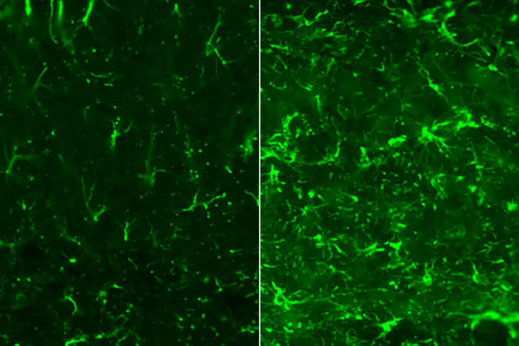Astrocytes are normal non-neuronal brain cells, but in their reactive form they can harm, rather than protect, brain tissue. Mice with tau tangles in their brains — a model of Alzheimer’s and related diseases — have fewer reactive astrocytes (green) in their brains when treated with the drug digoxin (left) than untreated mice (right). Researchers at Washington University School of Medicine in St. Louis have discovered that targeting astrocytes reduces tau-related brain damage and inflammation in mice, a finding that could lead to better therapies for Alzheimer’s and related tauopathies.