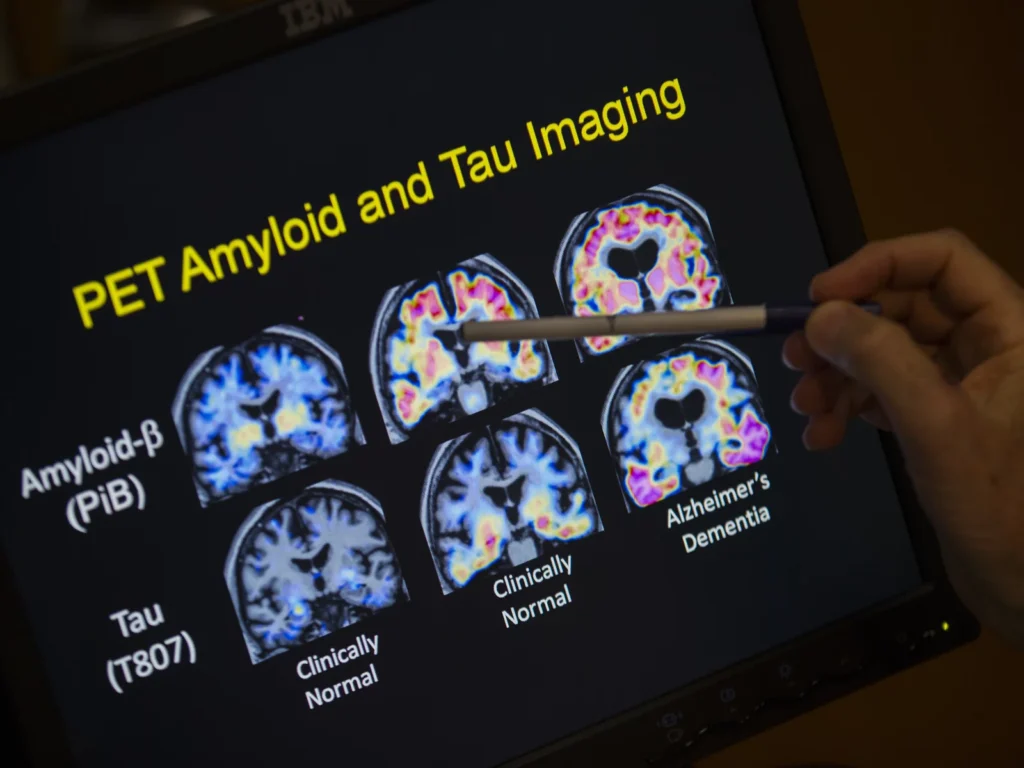 A doctor points to PET scan results that are part of Alzheimer's disease research. Much work in the field focuses a substance called beta-amyloid. A new study could test whether that's the right target.