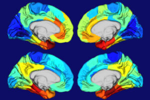 Red and orange areas on these heat maps of human brains show where the gene APOE is most active (top two brain images) and where tangles of the protein tau are most concentrated (bottom two brain images). APOE is the biggest genetic risk factor for Alzheimer’s, and tau tangles drive brain damage in the disease. The similarities in the two sets of maps suggested to researchers at Washington University School of Medicine in St. Louis that APOE plays a role in making certain brain areas particularly vulnerable to Alzheimer’s damage.