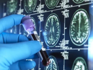 Newer blood tests can help doctors diagnose Alzheimer's disease without a brain scan or spinal tap. But some tests are more accurate than others.