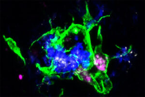 Scientists at Washington University School of Medicine in St. Louis have shown that treating mice with an antibody that blocks the interaction between APOE proteins (white) sprinkled within Alzheimer’s disease plaques and the LILRB4 receptor on microglia cells (purple) activates them to clean up damaging plaques (blue) in the brain. (Image: Jinchao Hou)