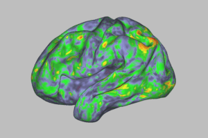 This heat map of brain activity patterns shows profound disturbance during an individual’s experience after taking psilocybin. Relatively stable patterns before and after the dose (blue and green hues) are temporarily scrambled during the "trip" (red, orange and yellow hues). Researchers at Washington University School of Medicine in St. Louis report that psilocybin destabilizes a critical network of brain areas involved in introspective thinking. The findings provide a neurobiological explanation for the drug’s mind-bending effects.