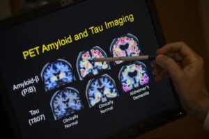 FILE - A doctor points to PET scan results that are part of a study on Alzheimer’s disease at Georgetown University Hospital, on Tuesday, May 19, 2015, in Washington. (AP Photo/Evan Vucci, File)