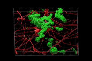 Researchers at Washington University School of Medicine in St. Louis have developed a way to study aged neurons in the lab without a brain biopsy, allowing them to accurately model the effects of aging in the development of late-onset Alzheimer's disease. Shown is a 3D reconstruction of amyloid beta plaque deposition (green) between neurons (red) grown in the lab. These neurons were transformed from human skin cells taken from patients with late-onset Alzheimer's disease.