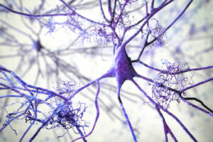 An illustration of what neuronal networks look like as they degrade. WashU researchers are working to design vaccines that could potentially prevent the buildup of inflammatory protein accumulations in the brain, which is one of the precursors to developing Alzheimer’s disease. (Image: Shutterstock)