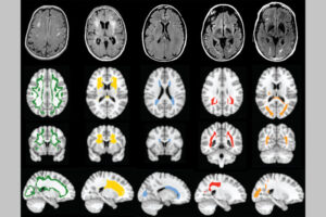 Brain scans reveal different patterns of white matter injury, highlighted in various colors, that result from cerebral small vessel disease, the second-leading cause of dementia. The National Institutes of Health have awarded a team of researchers at WashU Medicine a grant to investigate the underlying causes of cerebral small vessel disease.